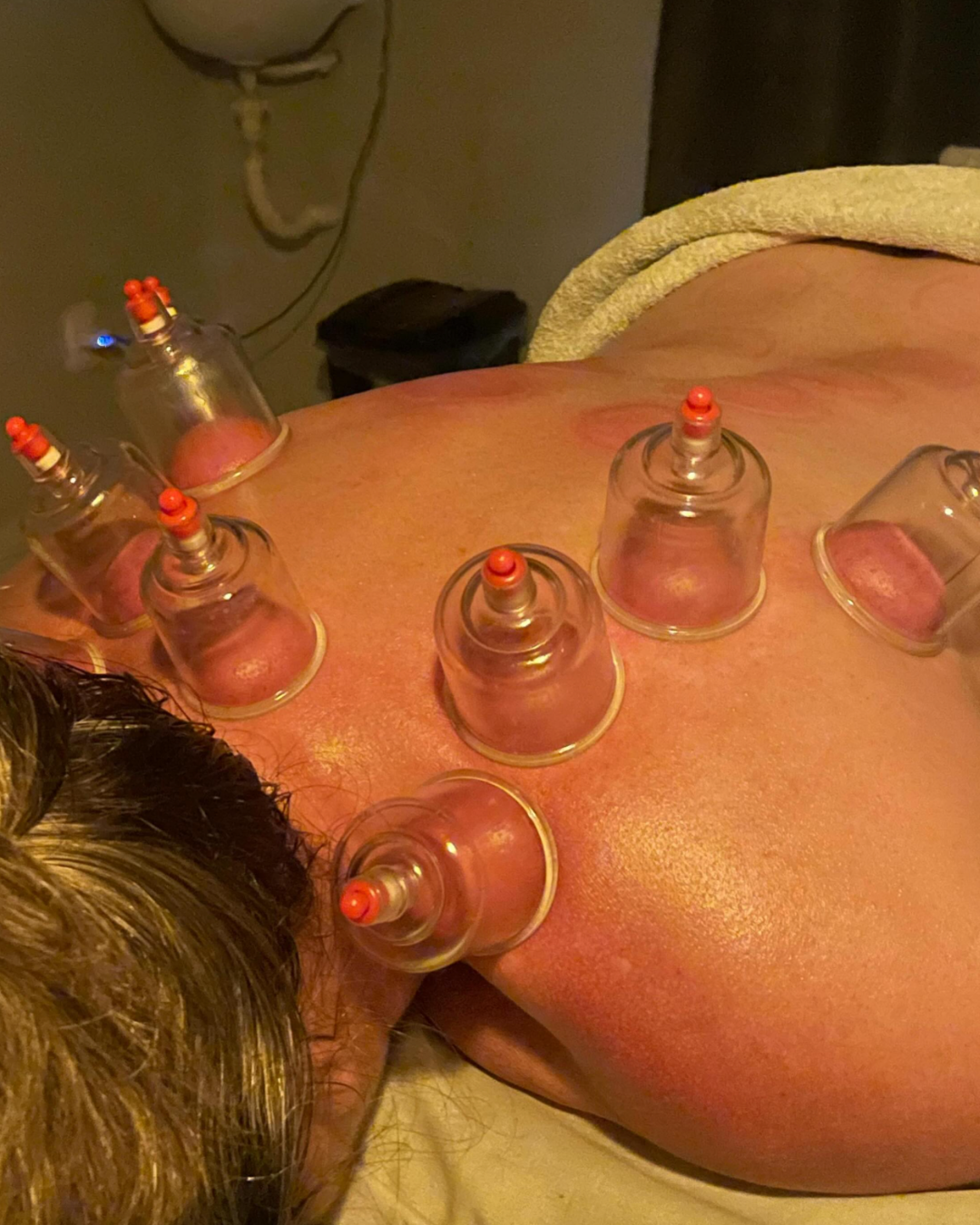 Ventosaterapia, um dos tratamentos de Massagem